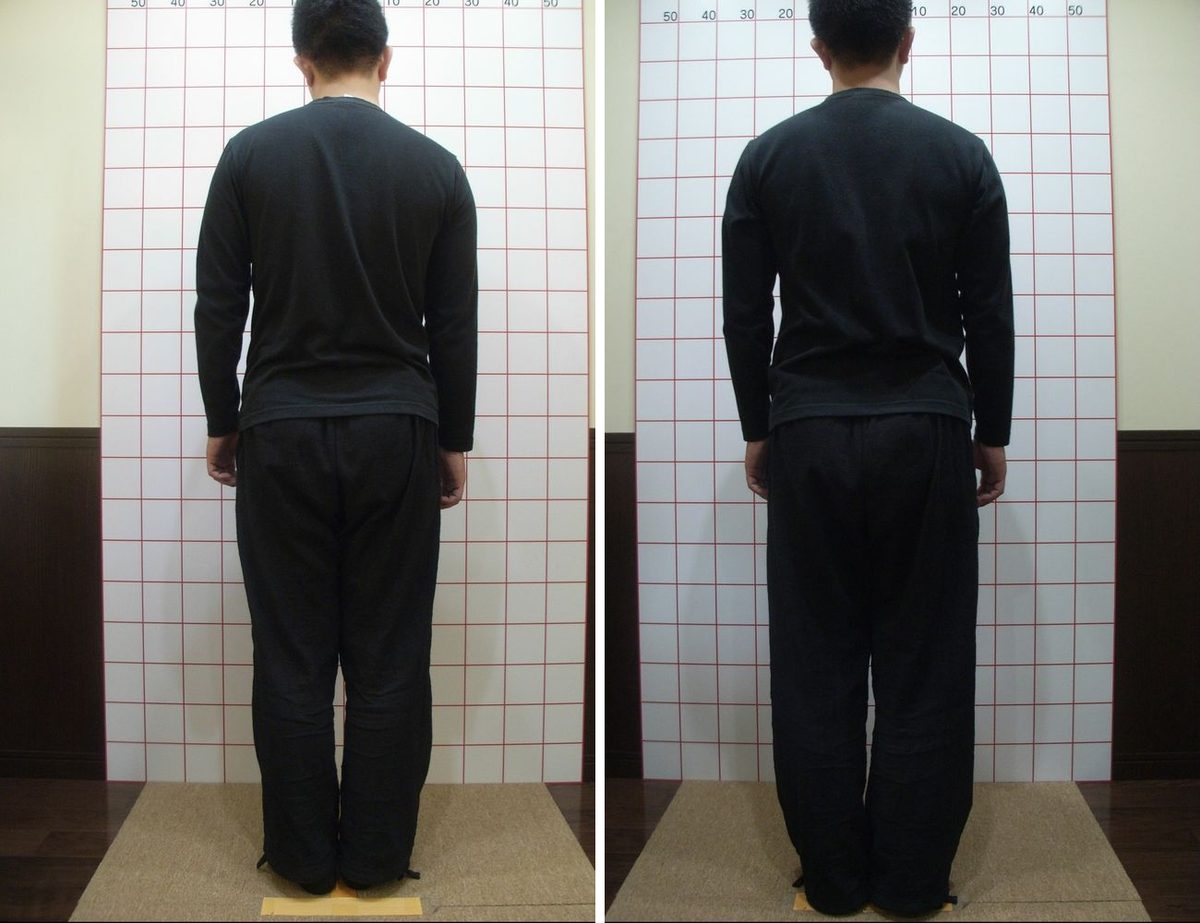 背面の左右差・肩の高さの施術前（左）と施術後（右）の比較写真