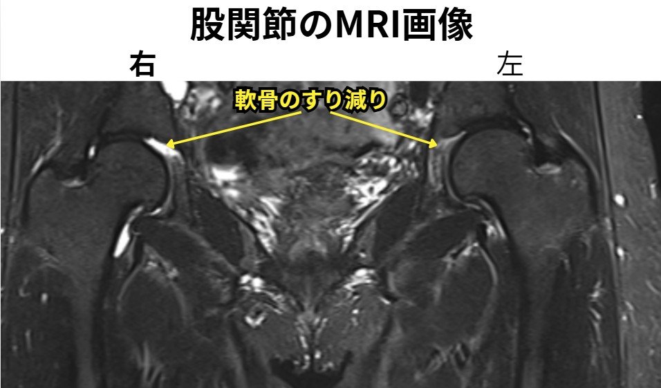 股関節のMRI画像　左右の軟骨のすり減りに矢印がある