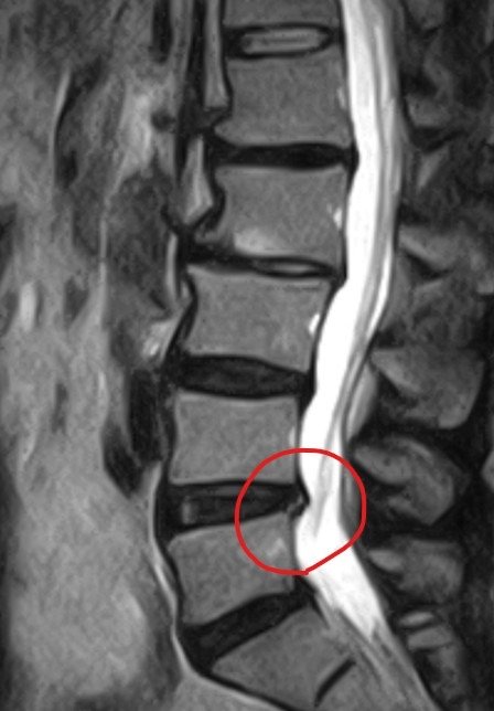 腰椎のMRI画像　軟骨のすり減り・腰椎すべり症・軽度の脊柱管狭窄症の部分に印がある