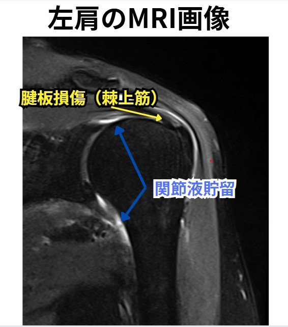 左肩のMRI画像　腱板損傷（棘上筋）と関節液貯留の部分に矢印がある