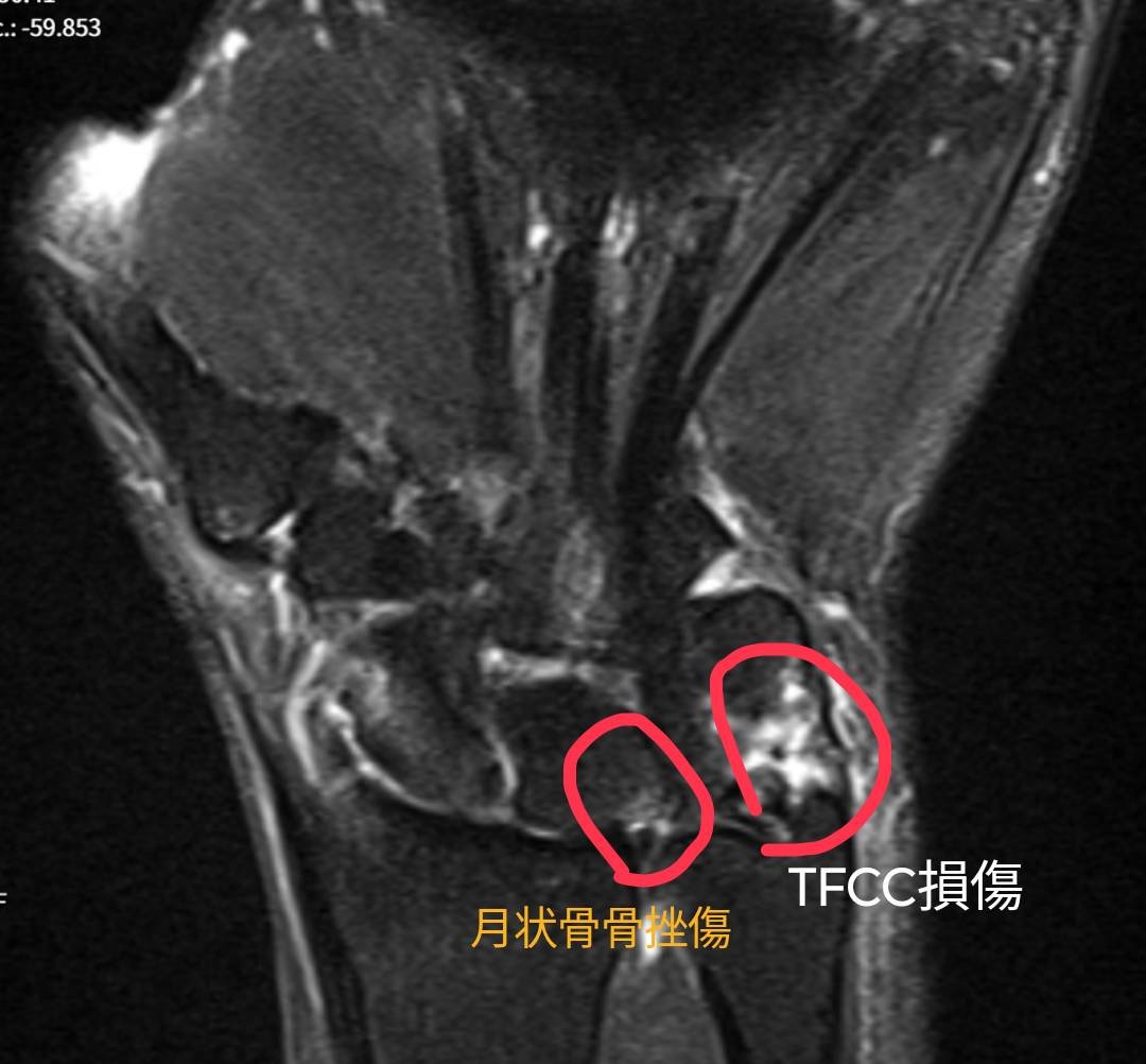 手首のMRI画像　月状骨骨挫傷とTFCC損傷の部分に印がある