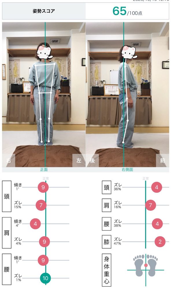 姿勢分析アプリの結果画面　姿勢スコア65点（顔は隠しています）